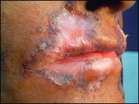 туберкулез кожи