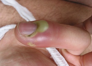 Нарыв на пальце как лечить. Нарыв на пальце возле ногтя — лечение и профилактика, частые причины нарывов