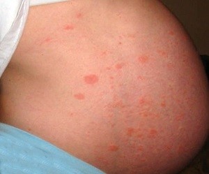 аллергия при беременности чем лечить