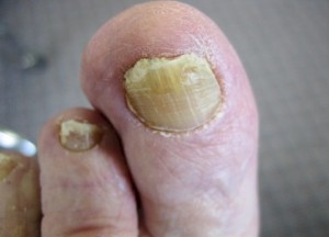 Как лечить грибок ногтей на ногах: все о ногтевом грибке