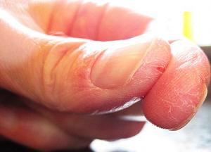 способы лечения трещин на пальцах рук