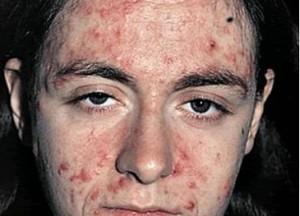 лечение демодекоза на лице