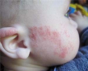 диатез на щеках у ребенка фото