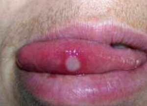 Основные симптомы инфекции полости рта