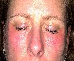 аллергический дерматит на лице фото