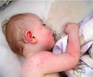 аллергический дерматит фото у детей
