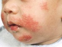 атопический дерматит у детей лечение
