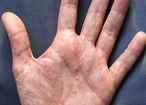 способы лечения дисгидроза кистей рук