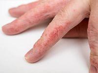 Как лечить себорейный дерматит изнутри thumbnail