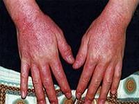 как лечить аллергический дерматит