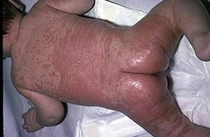 кандидозный пеленочный дерматит у детей фото