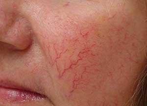 методы лечения купероза на лице