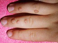 лечение бородавок на пальцах рук