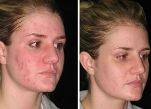 демодекоз лечение кожи лица фото