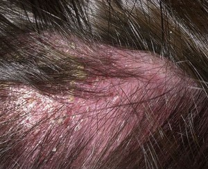 себорейный дерматит волосистой части головы фото