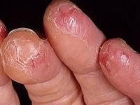 трещины на пальцах рук лечение