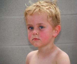 гиперемия кожи у детей фото