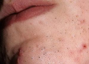 методы лечения и причины возникновения угревой сыпи на лице