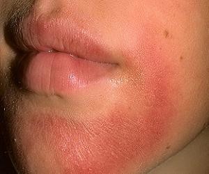 аллергия на солнце на лице у взрослых фото
