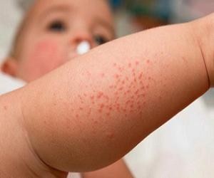 аллергическая сыпь у ребенка фото