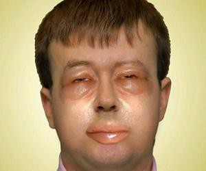 аллергия отек лица фото