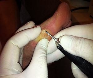 Как выглядит натоптыш на ноге лечение thumbnail