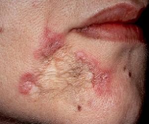 туберкулез кожи симптомы фото