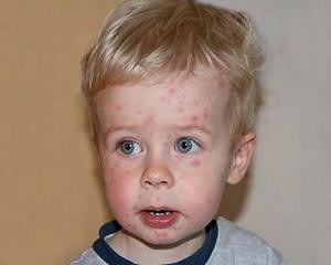 аллергическая сыпь у ребенка на лице фото