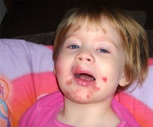 чем лечить стрептодермию  на лице у ребенка фото