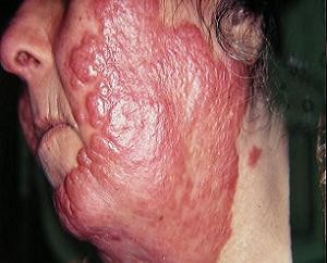 туберкулез кожи первые признаки симптомы фото