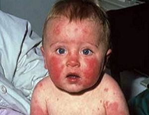 аллергия на лице у новорожденных грудничков фото