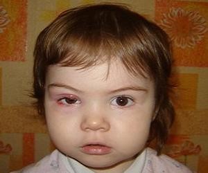 ячмень на глазу у ребенка фото лечение
