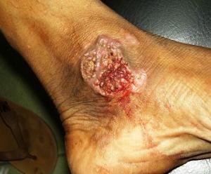 туберкулез кожи лечение фото
