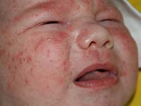 аллергическая сыпь у детей