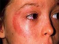 как избавиться от аллергии на лице