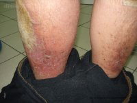 лечение микоза кожи
