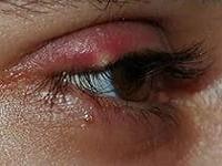 симптомы ячменя на глазу