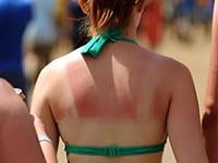 средство от солнечных ожогов кожи