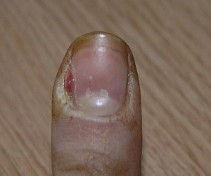 Как вылечить рану около ногтях thumbnail
