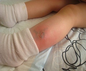 аллергия на укусы комаров у детей