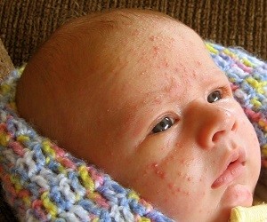 акне новорожденных или аллергия