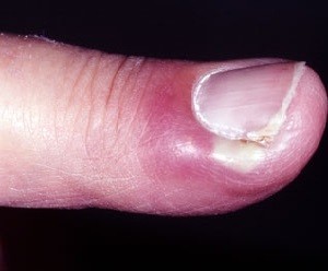 Как вылечить рану возле ногтя thumbnail