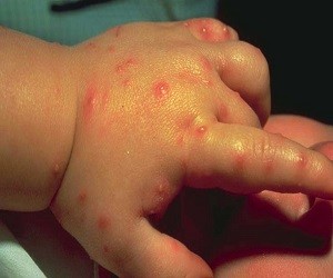 аллергия на укусы комаров у детей лечение
