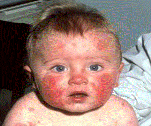 пищевая аллергия у детей лечение