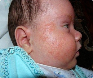 Жирная кожа лица у новорожденного thumbnail