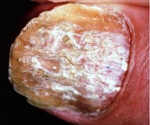псориаз ногтей лечение