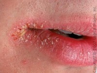 лечение заеды в уголках губ