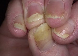 как лечить псориаз ногтей