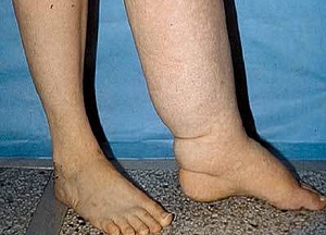 методы лечения отеков ног