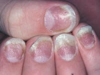 псориаз ногтей лечение в домашних условиях